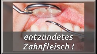 7 Lösungen gegen entzündetes Zahnfleisch [upl. by Laughry]