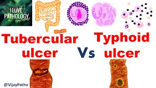 Intestinal ulcers TUBERCULAR VS TYPHOID ULCER [upl. by Soluk886]