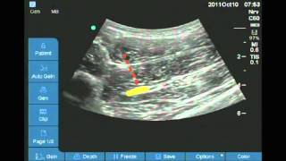 Ultrasound guided anterior sciatic nerve block [upl. by Sivert]