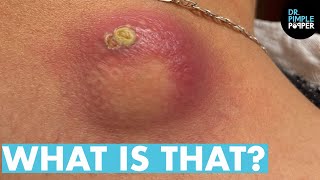 WHAT IS THAT Dr Lee Pops Satisfying Back Cyst  Dr Pimple Popper Reacts [upl. by Noellyn997]