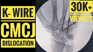 Kwire Fixation of CMC Carpometacarpal Joint Dislocation [upl. by Aryam]