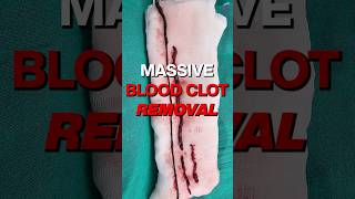 Shocking Footage Massive Blood Clot Removal From Artery shortsviral vascularsurgeon [upl. by Ahsial910]