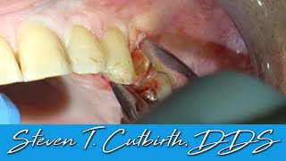 Extraction of Maxillary BiCuspid amp Grafting with PRF  Dental Minute with Steven T Cutbirth DDS [upl. by Macrae]