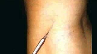 Tratamiento esclerosante de varices  Sclerosing Treatment of Varicose Veins  Sclerotherapy [upl. by Euqinomahs]