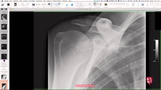 Upper Extremity Case Conference Shoulder Girdle [upl. by Letram842]