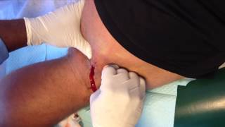 Draining Abscess from Hamstring [upl. by Retrop313]