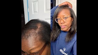 Alopecia Hair Growth Update 2022 [upl. by Leahicm210]