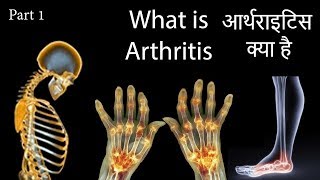 What is Arthritis  How to Cure Arthritis at Home in Hindi  आर्थराइटिस क्या है  Part 1 [upl. by Greysun173]