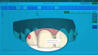 ClinCheck Pro IPR e Espaços  Sistema Invisalign  Blumenau SC [upl. by Kciderf]