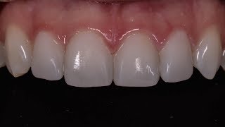 Composite Veneers [upl. by Lamrert]