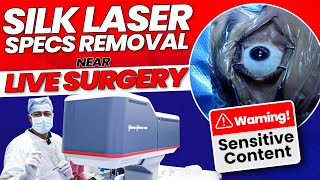 SiLK Laser Specs Removal  Near LIVE Surgery by Dr Rahil Chaudhary [upl. by Hinckley]