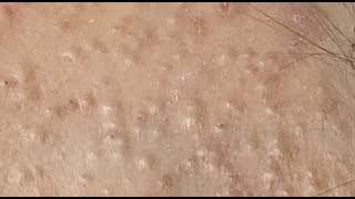 How to treat acne during pregnancy HoangMySpa122 [upl. by Nonad654]