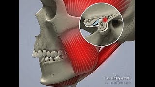 TMD  Temporo Mandibular Disorders [upl. by Lazaruk220]