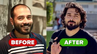 My Remarkable Hair Transplant Journey  From Baldness to Boldness [upl. by Bonnice941]