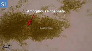 Amorphous Phosphate Crystals in Urine [upl. by Bonnell982]