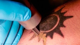 How Laser Tattoo Removal Works  Smarter Every Day 123 [upl. by Irwinn]