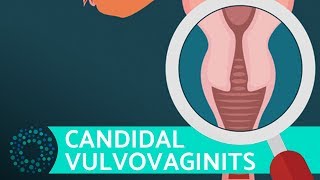 What Is Vaginitis  VULVOVAGINITIS [upl. by Bradford]