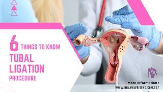 6 Things to Know About Tubal Ligation Procedure [upl. by Sissie524]