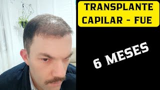 TRANSPLANTE CAPILAR  FUE 6 MESES  ESTOU SATISFEITO COM O RESULTADO [upl. by Aland]