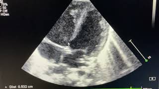 Partial AV septal Defect with Ostium Secundum ASD [upl. by Ominoreg126]