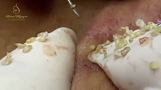 Loan Nguyen Acne Treatment 16477 [upl. by Derr278]