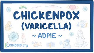 Chickenpox Varicella Nursing Process ADPIE [upl. by Nachison]