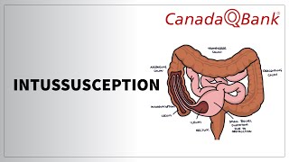 Intussusception [upl. by Leahcimal]