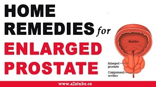 Enlarged Prostate – Natural Ayurvedic Home Remedies [upl. by Ahsiner175]