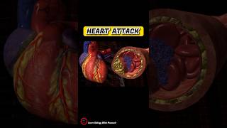 Heart attack short animation  Heart attack cause  cardiology shorts [upl. by Frederico]