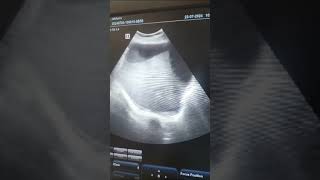 Pleural Effusion with Ascites ultrasounds cans sonography sonographer viral short [upl. by Callan]