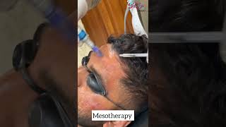 Mesotherapy microneedling mesothmesothprp youtube [upl. by Eisnyl]