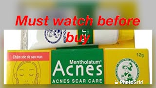 Mentholatum Acne scar gel After 5 months used review must watch before buy [upl. by Amary479]