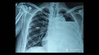 Hydropneumothorax Chest X Ray [upl. by Malcolm]