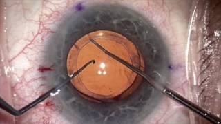 Rotated Toric repair 2 years post cataract surgery by Steven G Safran MD [upl. by Jamilla]