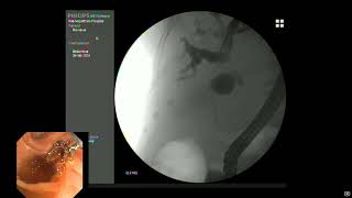 Hilar Cholangiocarcinoma Bismuth type 2  Palliative treatment with bare SEM 10x100mm to right duct [upl. by Emile]