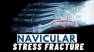 Navicular Stress Fractures  Symptoms Causes Diagnosis amp Treatment [upl. by Garwin]