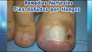 Hongos en los pies remedios naturales para curarlos [upl. by Rorrys109]