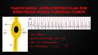 21 TAQUICARDIA SUPRAVENTICULAR POR REENTRADA NODAL [upl. by Kohler]