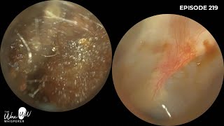 220  Difficult Ear Wax Removal in Narrow Ear with the WAXscope [upl. by Anelav]