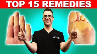 Raynauds Syndrome Top 15 Remedies Symptoms amp Best Treatment [upl. by Cari]