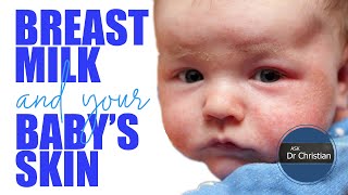 Can BREASTMILK upset your babys SKIN Could there be an ALLERGY [upl. by Namra]