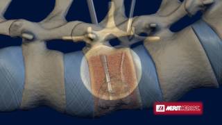 STAR™ Tumor Ablation System [upl. by Adnala]