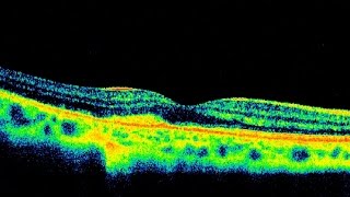 Choroidal Neovascularization [upl. by Marrilee]