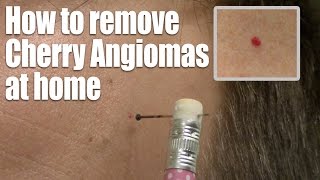 How to remove Red Skin Dots at home Quick amp Easy Cherry Angioma treatment [upl. by Comethuauc]