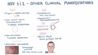 HSV  Clinical Presentation  Part 2 [upl. by Kolk]