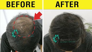 Dermaroller for Hair Loss Is It Effective How to Use a Derma Roller on Your Scalp for Hair Growth [upl. by Coulson]