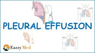 Pleural Effusion Causes ClassificationSymptoms and Treatment [upl. by Inaleon]