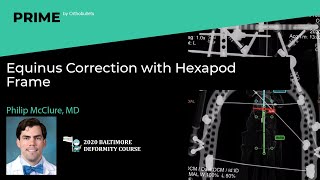 Equinus Correction with Hexapod Frame  Philip McClure MD [upl. by Liban]