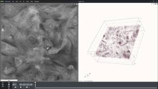 Slice of xenograft of human breast cancer in mouse Cell line MDAmb2312 [upl. by Lianne]