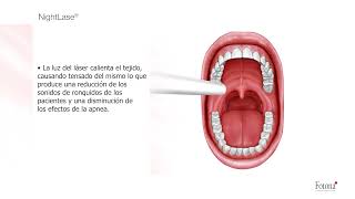 NightLase Tratamiento Laser para Ronquidos y Apnea en Carmen Sarmiento [upl. by Nollek]